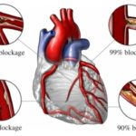 Δυσλιπιδαιμία