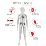 Αρτηριακή Υπέρταση